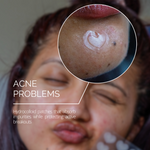 Patchly Hydrocolloid Pimple Patches – 36 Pack